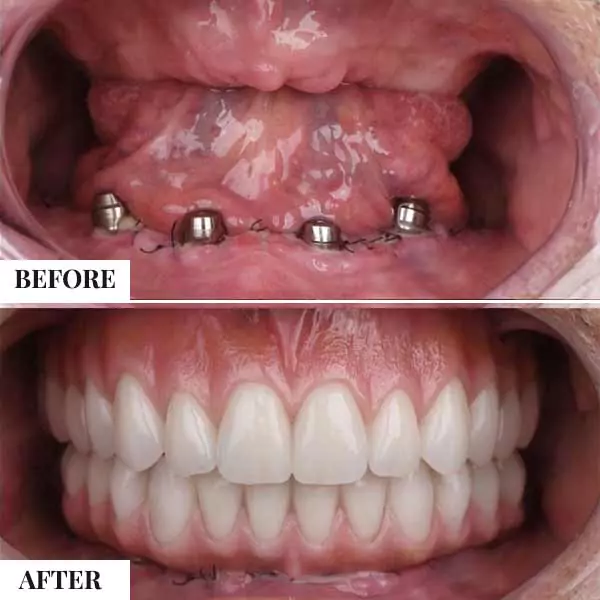 Dental Implant Case