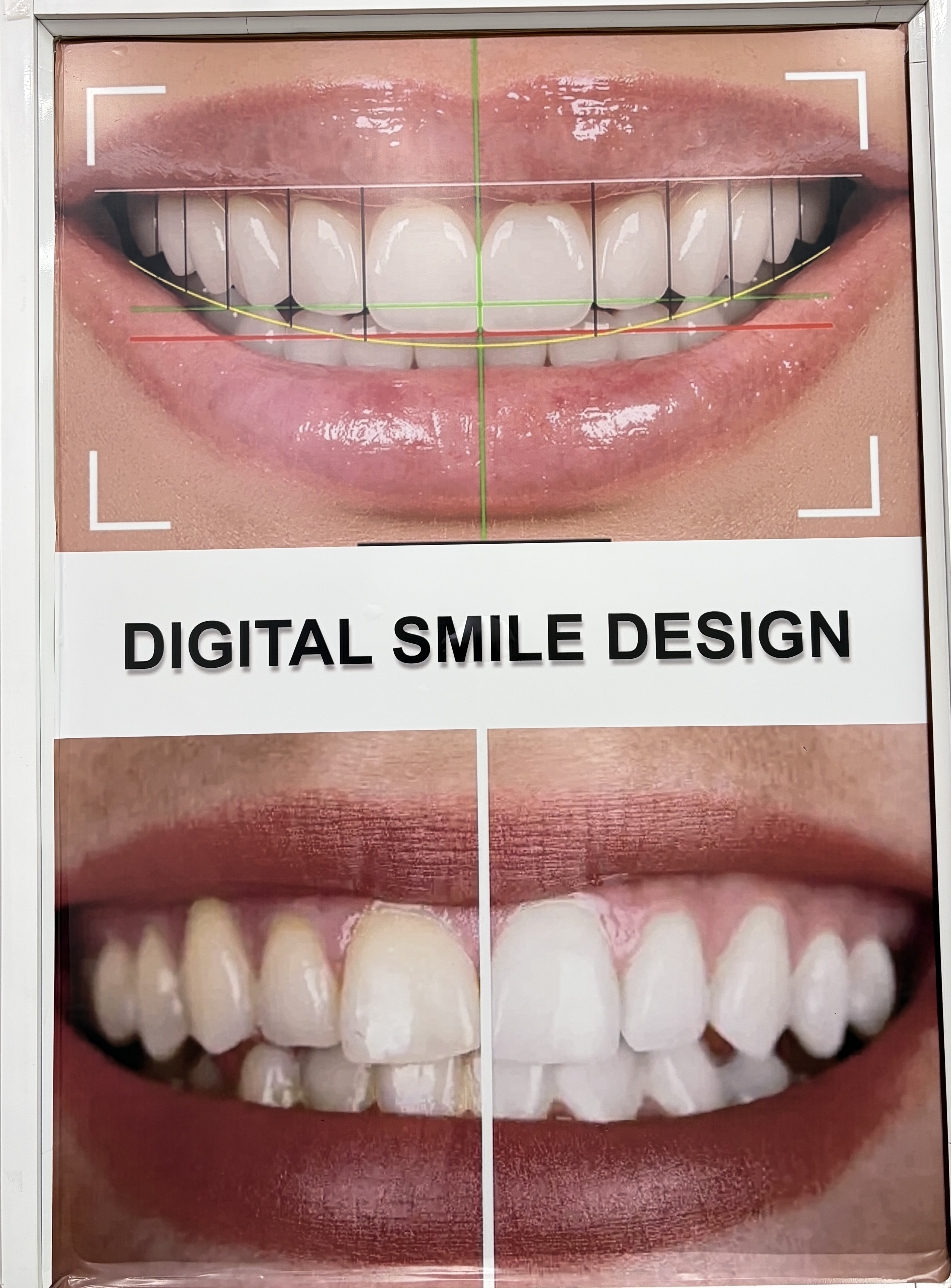 Smile Makeover